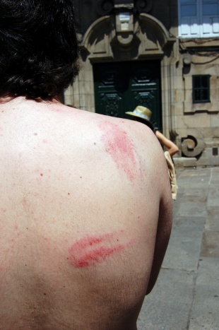 Imaxe dun dos feridos nas cargas, fotografado o día a seguir